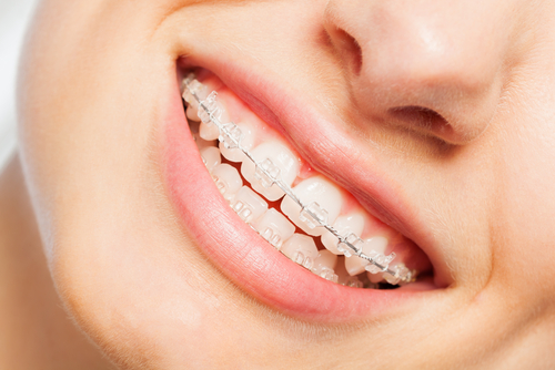 get braces